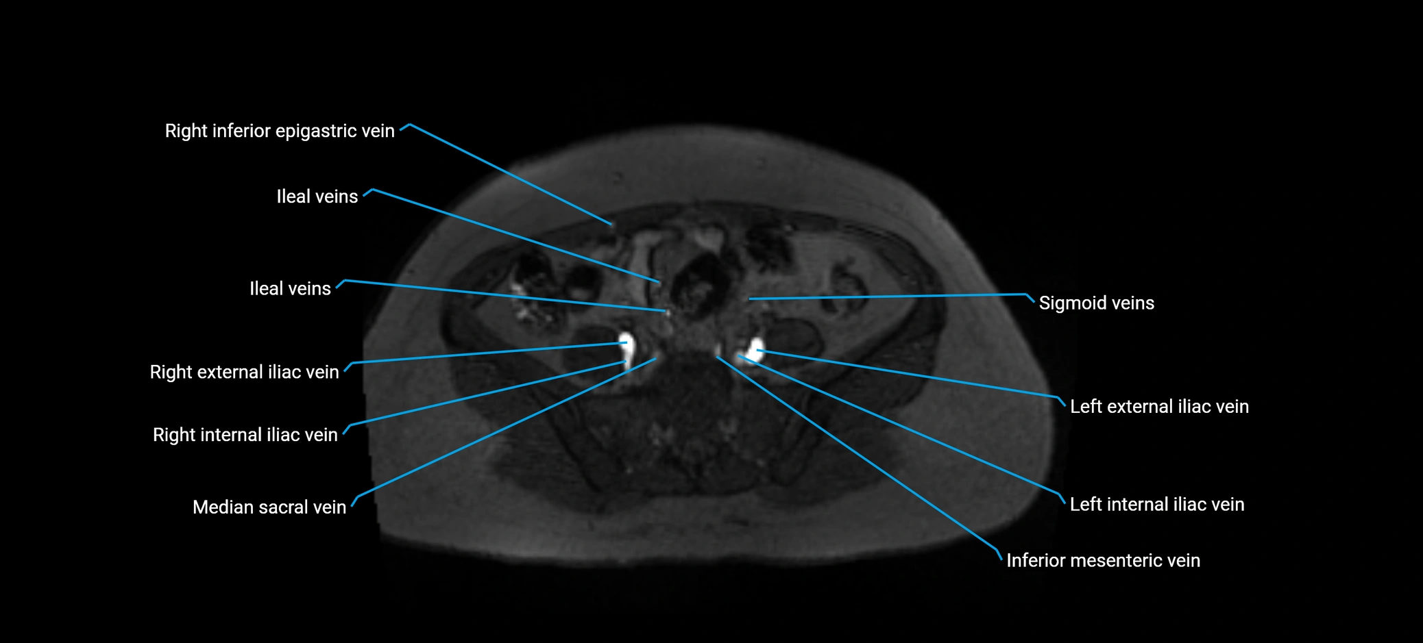 MRV abdomen pelvis & lower limb axial cross sectional anatomy labelled MRI image 133 (1).webp